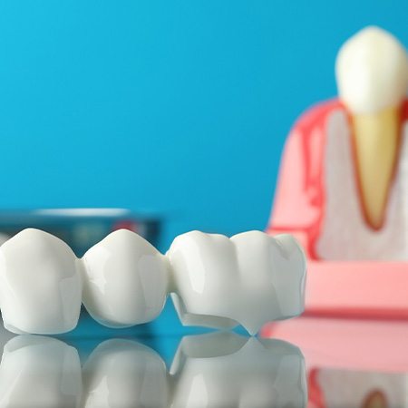 Dental bridge in front of sample implant on reflective surface with blue background
