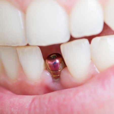 A single dental implant fusing to a patient’s jaw