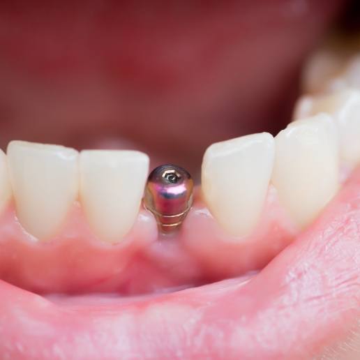 Close up of person smiling with a dental implant in Hammond