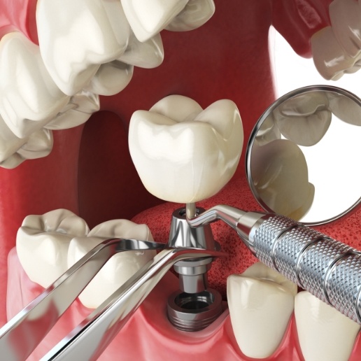 Animated dental implant in the lower jaw