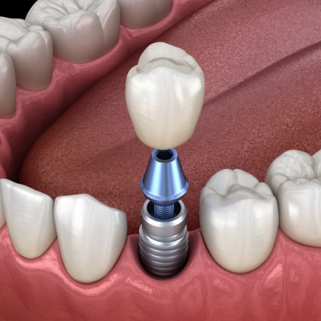 Dental implant with dental crown replacing one missing tooth