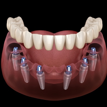 Six dental implants supporting a full denture