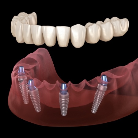 All on 4 implant denture replacing a full row of teeth