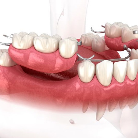 Illustration of a partial denture for lower dental arch