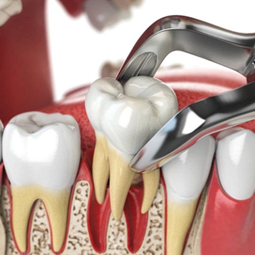 a 3D depiction of a tooth extraction