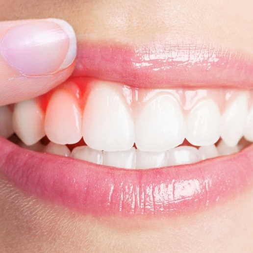 Close up of person with red gums who needs gum disease treatment in Hammond