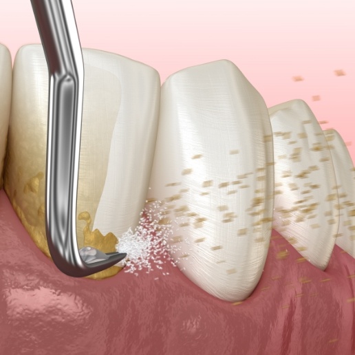 Animated dental tool removing plaque buildup from teeth