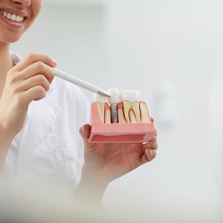 a dentist holding a model of dental implants