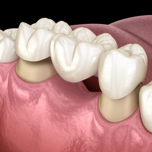 Animated dental bridge replacing a missing tooth in Hammond