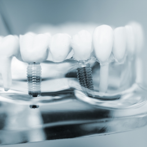 Model of the jaw with two dental implants