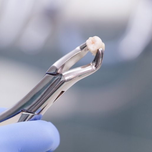 Extracted tooth being held in pair of dental forceps