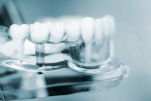 Dental implants proudly displayed on a clear plastic model